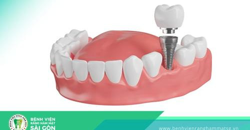 tác hại của việc trồng răng implant