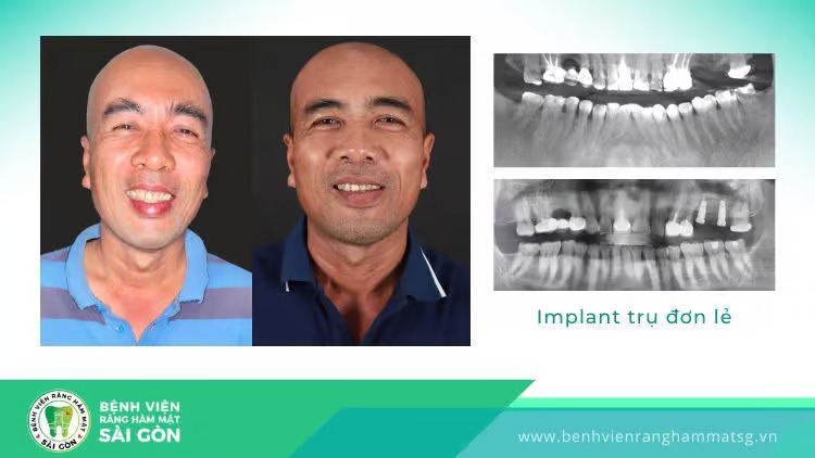 tác hại của việc trồng răng implant