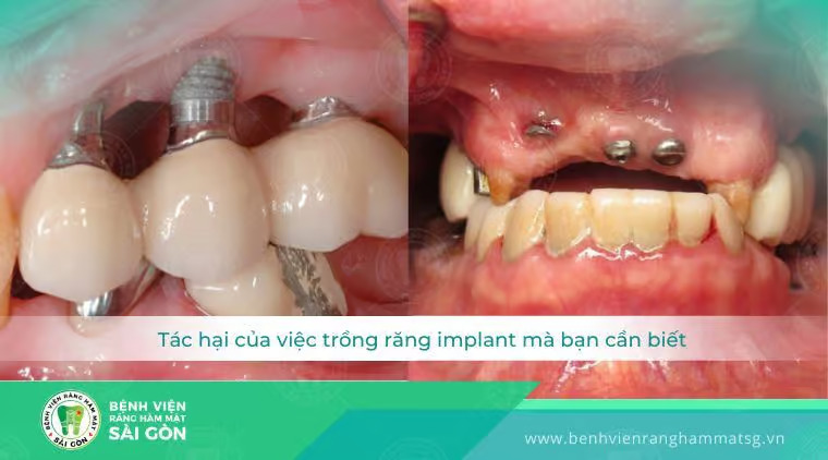 tác hại của việc trồng răng implant