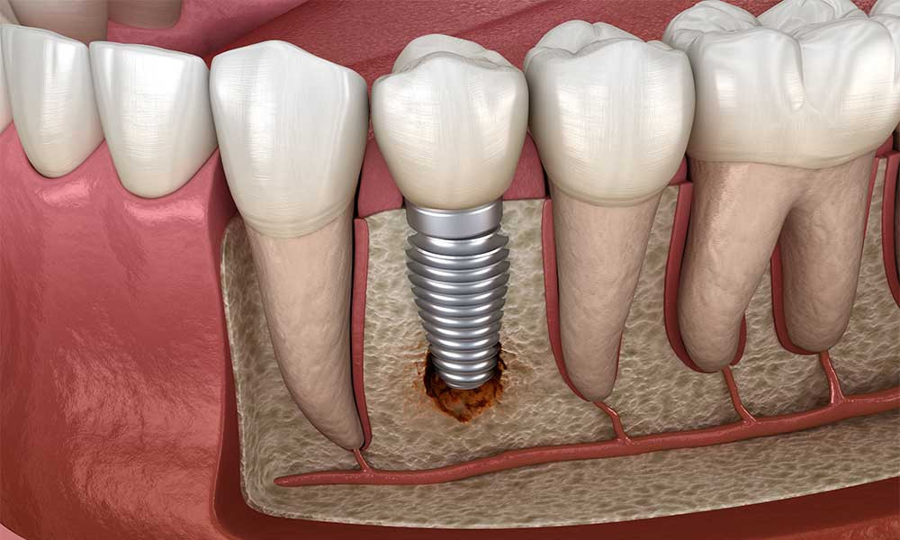 Vùng cấy bị nhiễm trùng